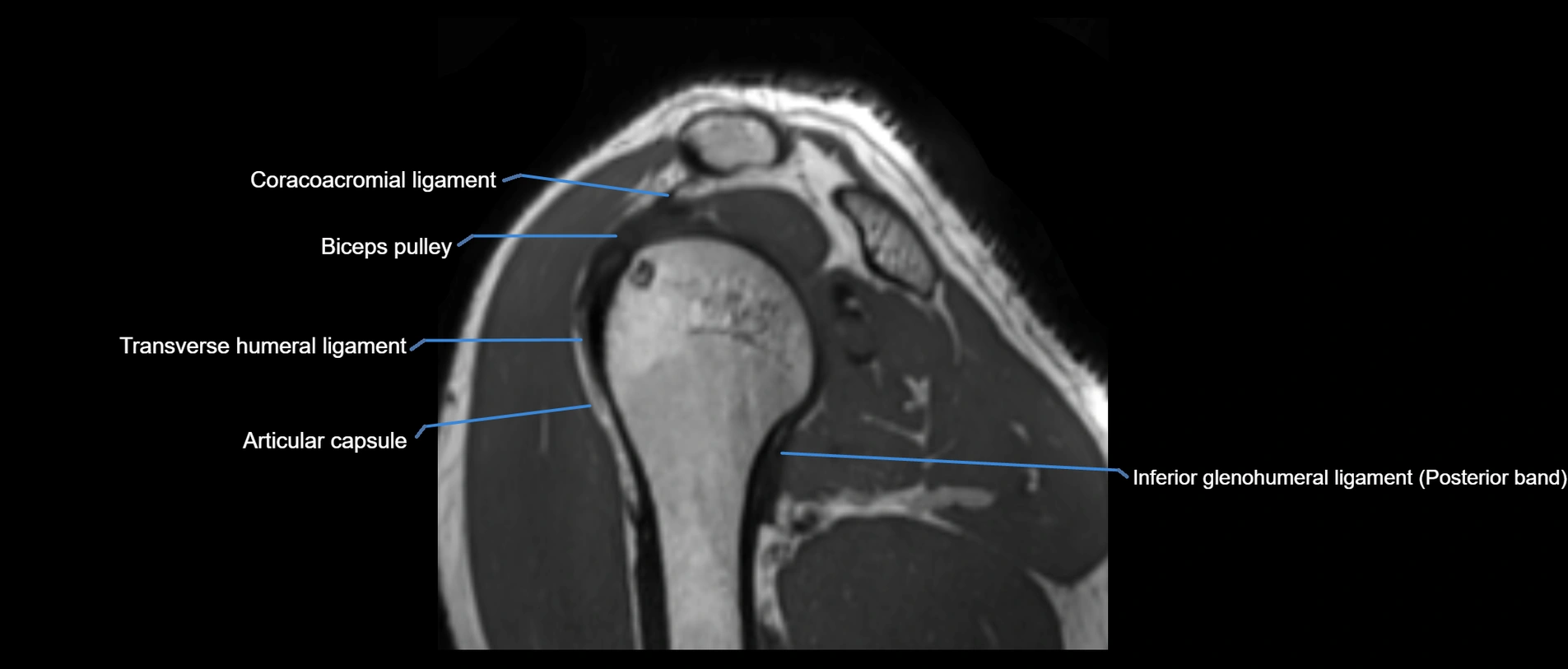 shoulder ligaments sagittal  cross sectional anatomy 3T MRI AI enhanced radiology image -img-00001-00038.webp